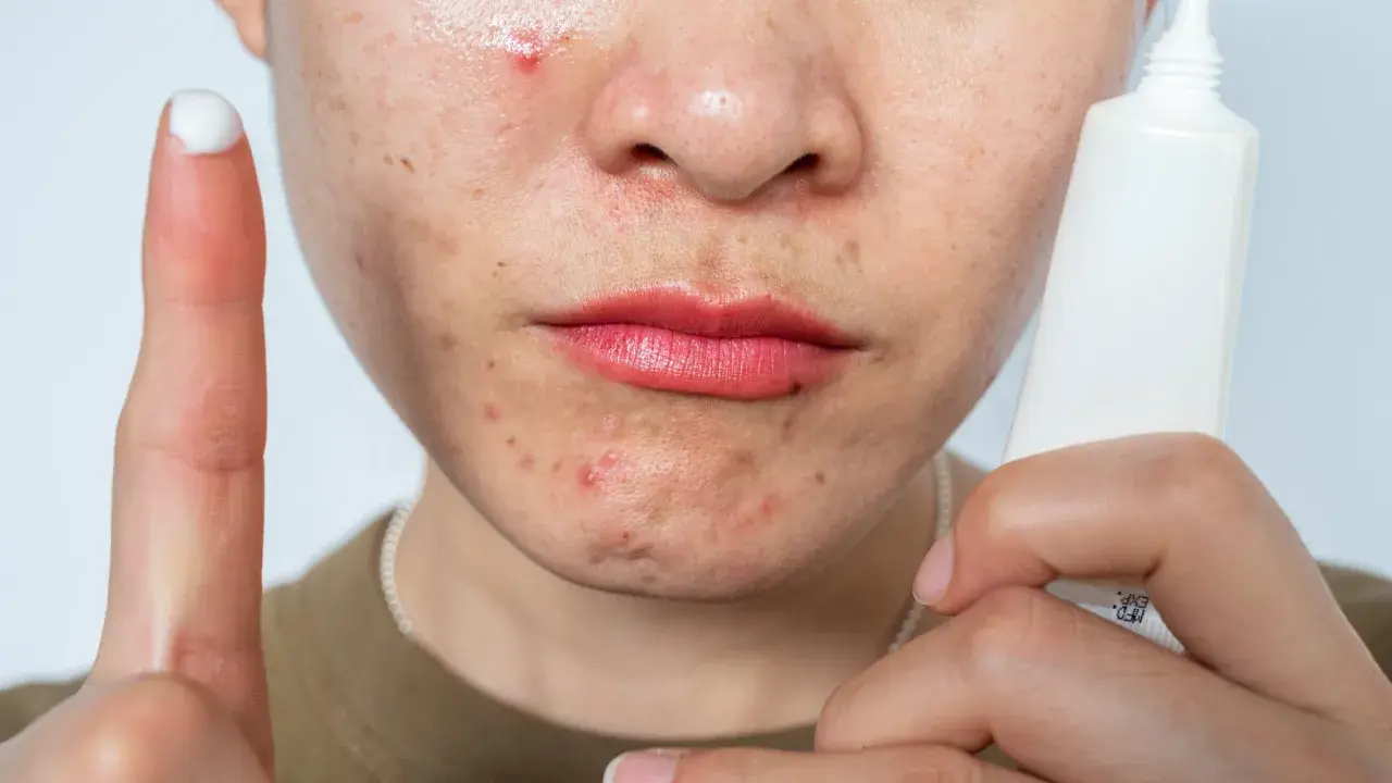 A person's face shows acne and redness, possibly from retinol burn. A finger with cream and a tube of skincare product are visible.