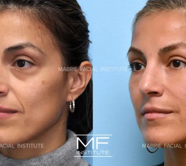 Before and after images show a woman's face, highlighting the reduction of nasolabial folds after a facial massage.